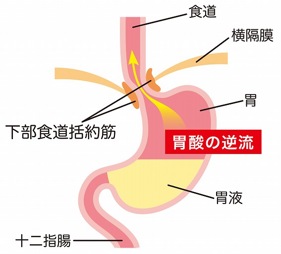 逆流性食道炎イラスト